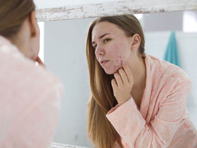 Jak se zbavit akné v dospělosti?