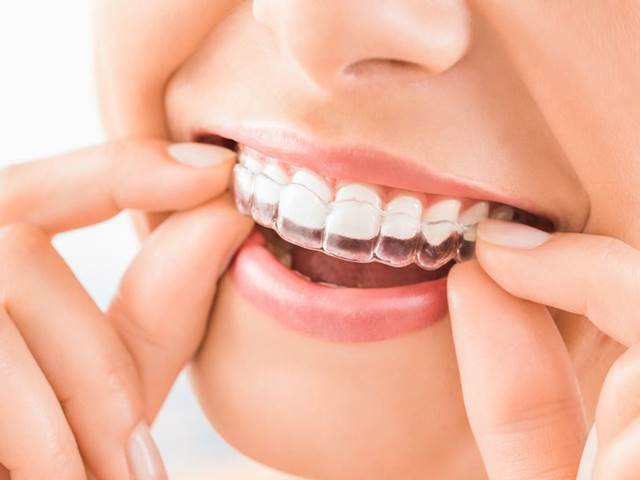 Rovnátka Invisalign = moderní přístup k léčbě vad chrupu