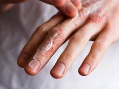 Popraskaná kůže je vstupní branou pro infekce